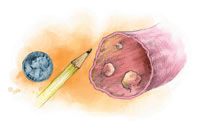 Биопсия полипа кишечника что это. Polyp Size. Биопсия полипа кишечника что это фото. Биопсия полипа кишечника что это-Polyp Size. картинка Биопсия полипа кишечника что это. картинка Polyp Size.